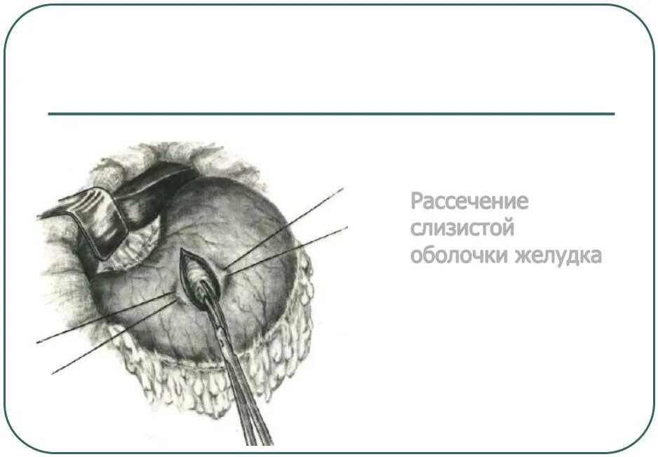 Рассечение белочной оболочки. Рассечение желудка на латыни. Книга рассечение стоуна