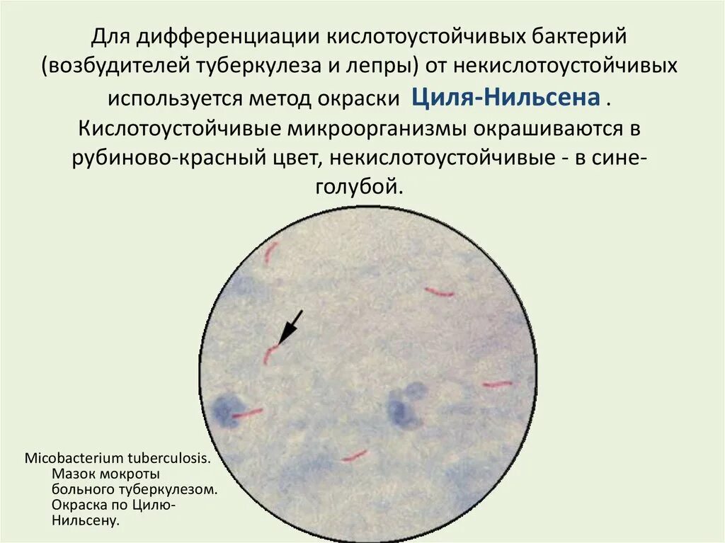 Метод окраски кислотоустойчивых бактерий по Цилю-Нильсену. Окраска кислотоустойчивых бактерий по Цилю Нильсену. Микроскопия по Цилю Нильсену туберкулез. Кислотоустойчивые бактерии по Цилю Нильсену. Анализ мокроты на микобактерии