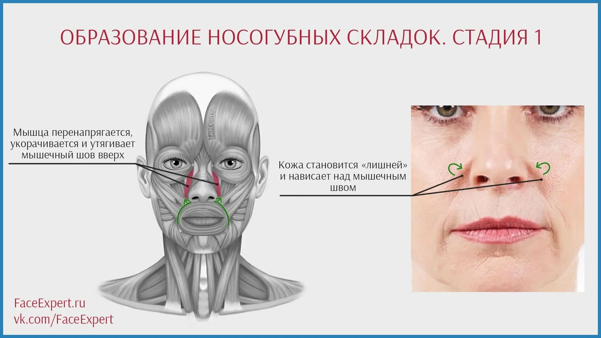 Левый угол рта. Мышцы лица носогубные складки. Мышца поднимающая верхнюю губу и крыло носа. Носогубная складка мышцы. Мышца прднимающая вкпхнюю НУБУ И крылр носа.