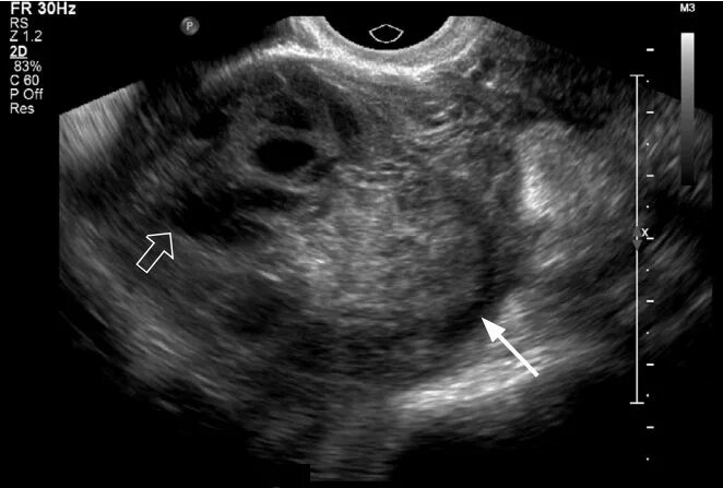 Внематочная беременность на УЗИ. Эктопическая беременность УЗИ. Внематочная яичниковая беременность на УЗИ. Трубная беременность УЗИ.