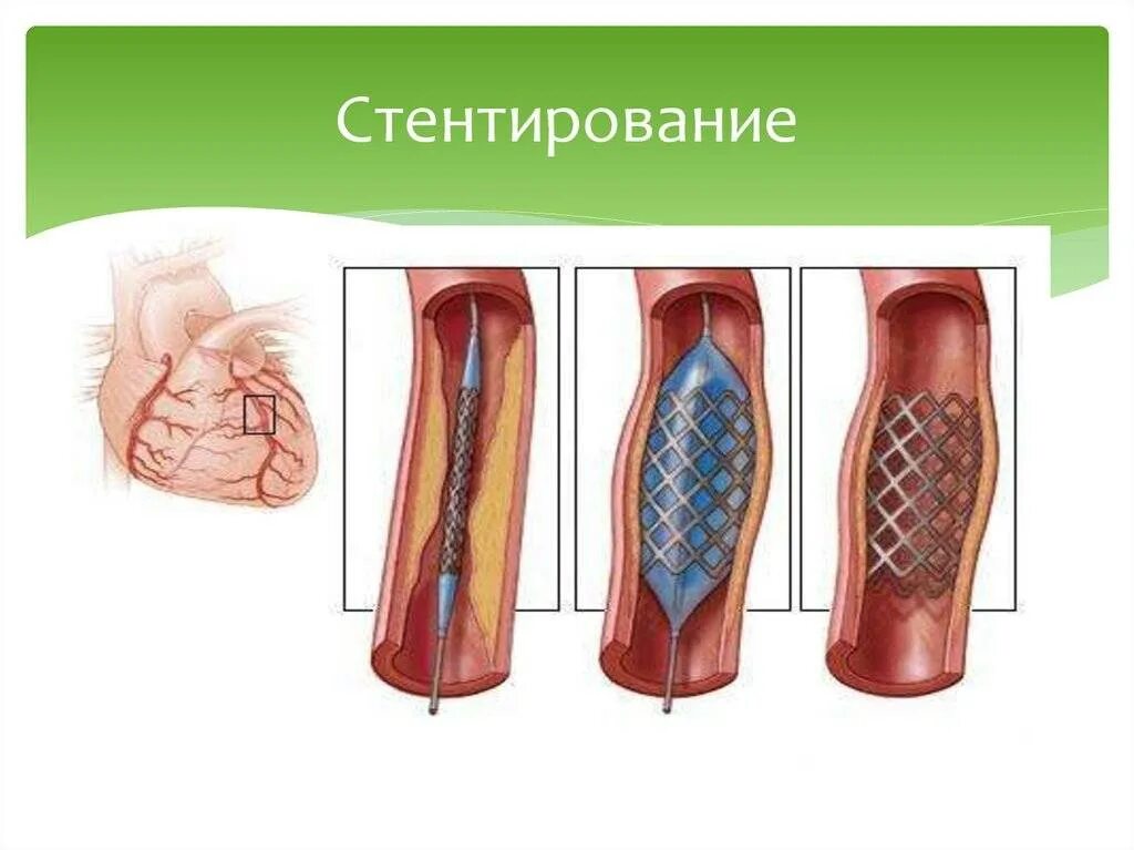 Можно ли кофе после стентирования