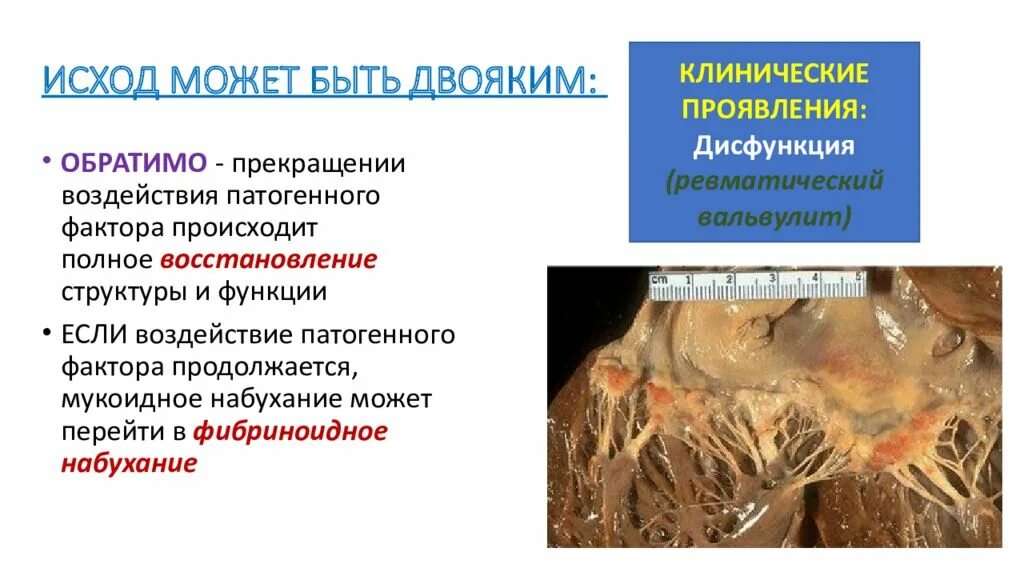 Вальвулит это. Мукоидное набухание клинические проявления. ревматический вальвулит. фибриноидное набухание исход.