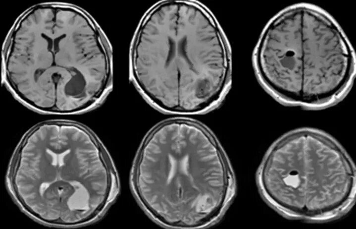 Эхинококкоз головного мозга мрт. Atrophy головного мозга мрт. Атрофия коры головного мозга мрт. Мультисистемная атрофия головного мозга на мрт. Многоочаговое поражение головного мозга