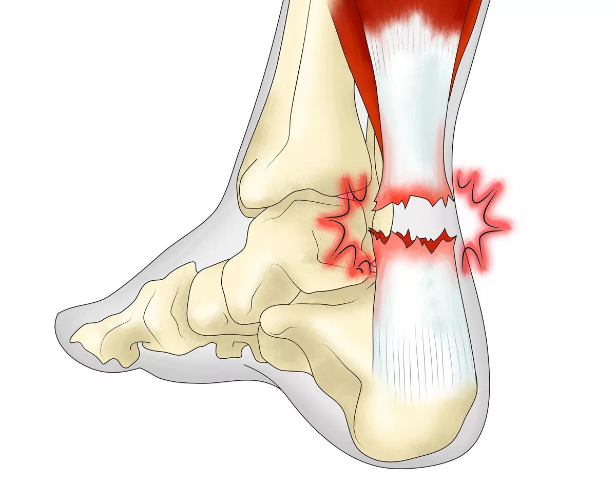 Боль в области голеностопного сустава. Разрыв аххилесова сухожилия. Разрыв Ахилесова мухожишич. Разрыв ахилесого суходилия. Разрыв ахиллесова сухожилия стопы.