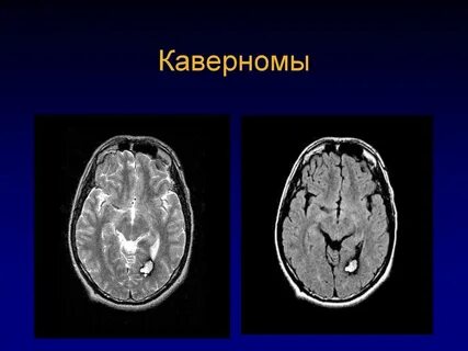 Кавернома головного