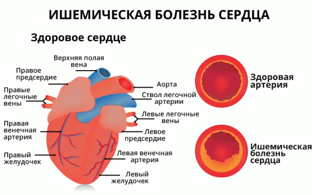 Сколько живут с ишемией