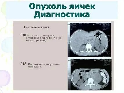 Опухло яичко у мужчины и болит