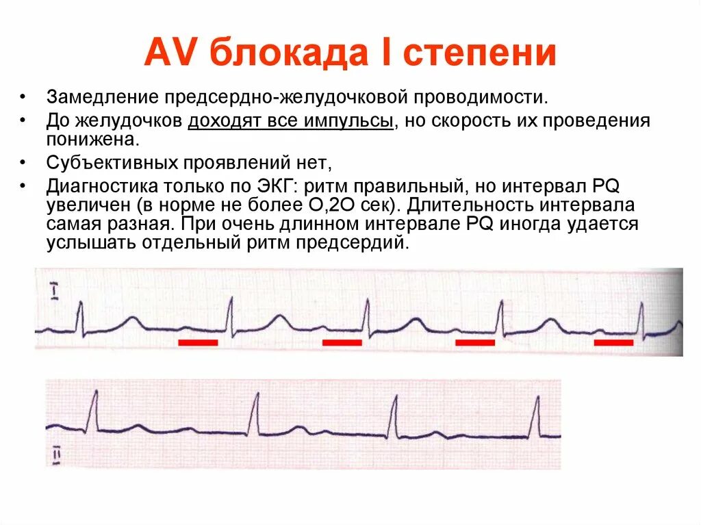 Блокада сердца это опасно. ЭКГ при атриовентрикулярной блокаде 1 степени. АВ блокада 1 степени на ЭКГ. Атриовентрикулярная блокада 1 степени на ЭКГ. Антро вентрикулярная блокада 1 степени.