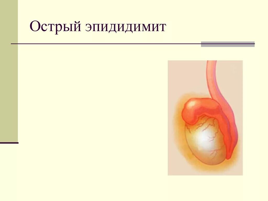 Эпидидимит придатка яичка. Гонорейный эпидидимит. Воспаление придатка яичка – эпидидимит.. Острый левосторонний эпидидимит. Болит в правом яичке у мужчин