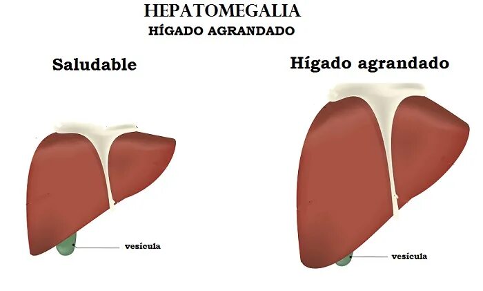 Гепатоза гепатомегалии. Размеры печени при гепатомегалии. Увеличение размеров печени. Увеличение печени причины. Диффузные изменения печени.