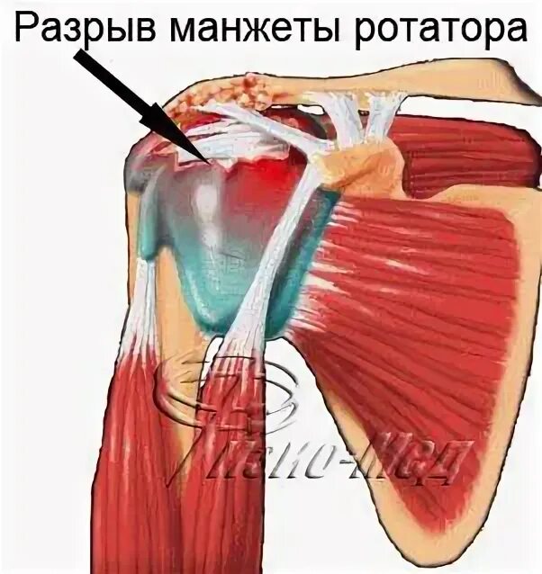 Повреждение вращательной манжеты мкб. Плечелопаточный периартрит плечевого сустава. ротаторная манжета плечевого сустава. повреждение ротаторная манжета. ротаторная манжета плечевого сустава анатомия.