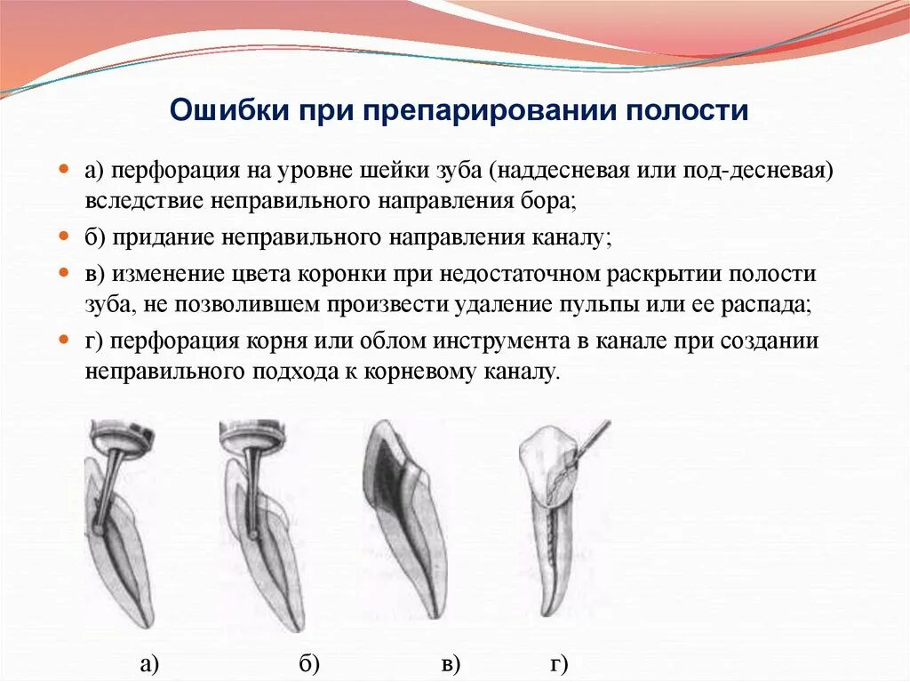 Препарирование корневого канала