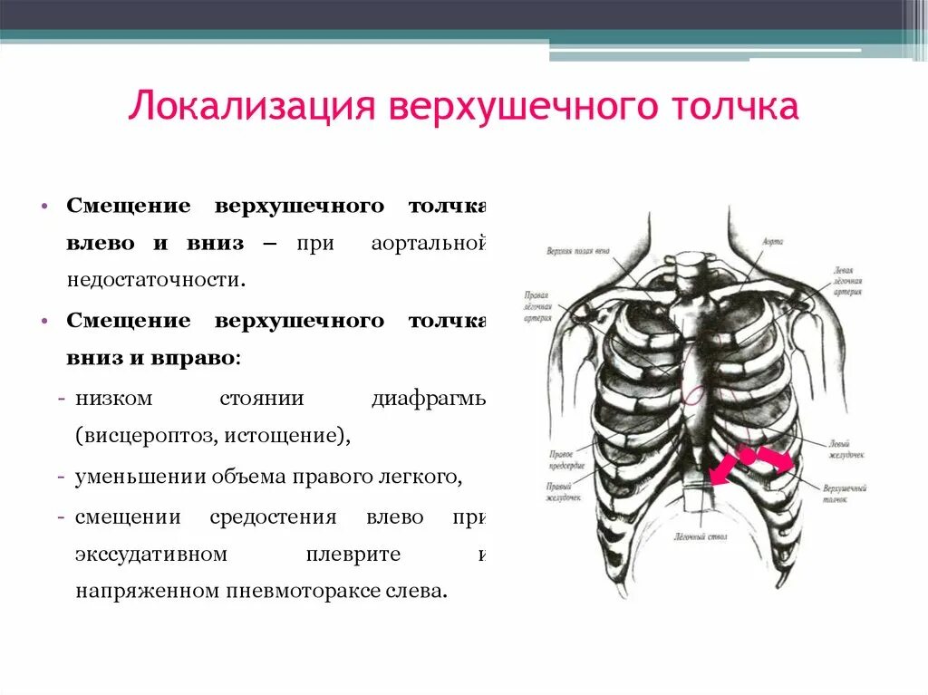 Верхушечный толчок при гипертрофии. Локализация верхушечного толчка. смещение верхушечного толчка. верхушечный толчок смещается влево и вниз при.