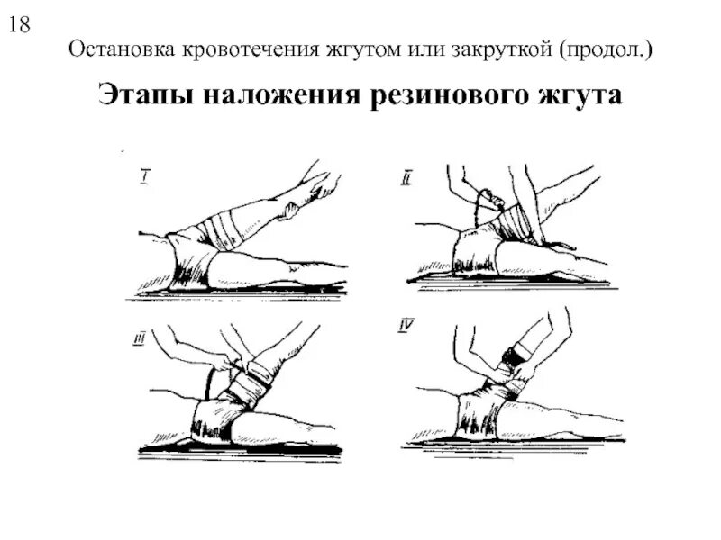 Артериальное кровотечение нижних конечностей. Наложение жгута для остановки кровотечения. Временная остановка кровотечения жгута закрутки. Остановка кровотечения накладывание жгута;. Остановка кровотечения наложение жгута алгоритм.