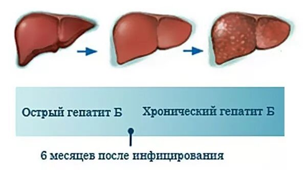 Работать с гепатитом б. Хронический вирусный гепатит б формы. Острая и хроническая формы гепатита. Острая форма гепатита б.