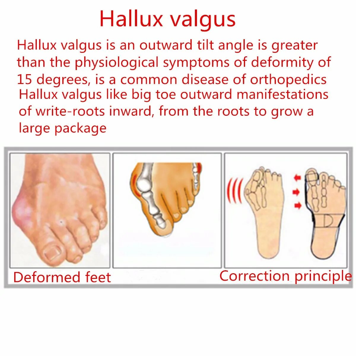 Hallux valgus степени рентген. Халюс вальгус степени на рентгене. Hallux valgus стадии рентген. Hallux valgus 2 степени армия. Hallux valgus что это