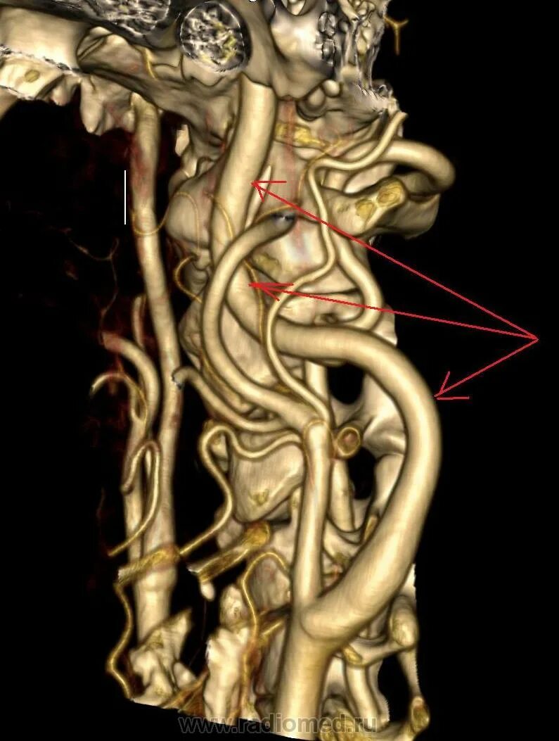 Аневризма сонной артерии что это. Аневризмы Виллизиева круга. Аневризма внутренней сонной артерии кт. Кт аневризмы сонной артерии.
