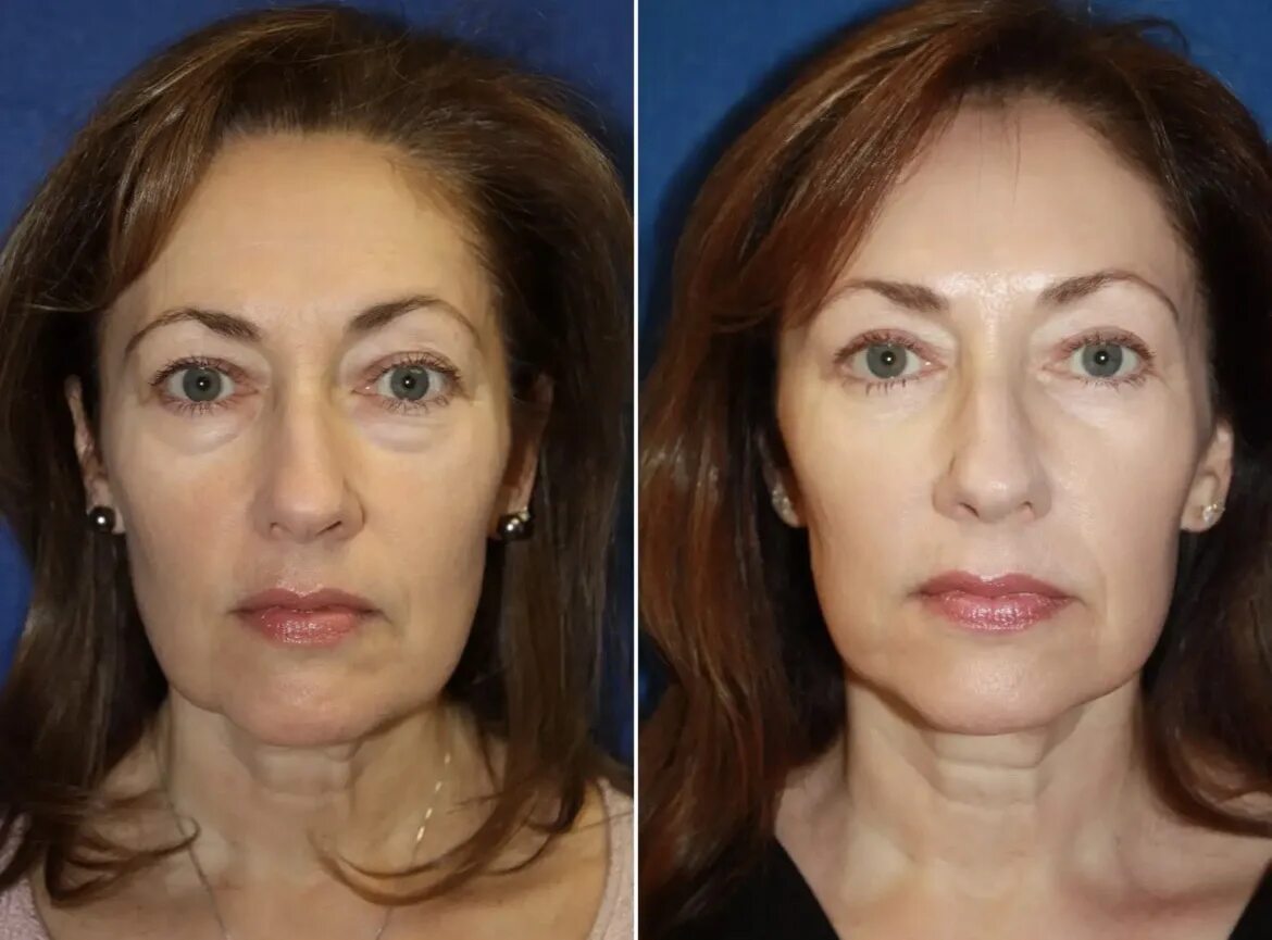Липодистрофия до и после. Филлеры под глаза до и после. Ботокс для лица. Омоложение форум. Лазерное омоложение лица до и после.