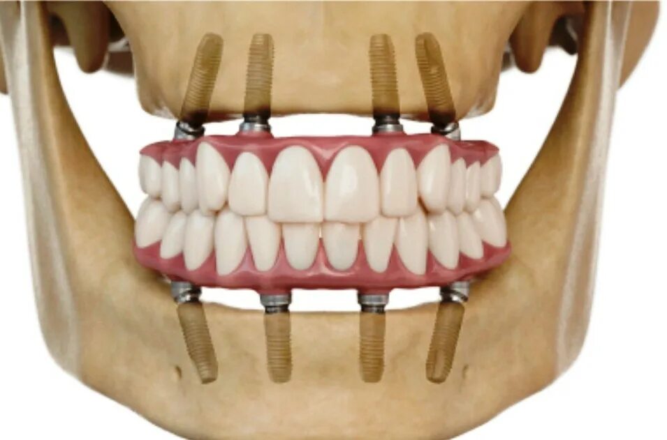 Несъемный протез на 4 имплантах. Балочный протез на имплантах. Протез на 4 зуба несъемный.