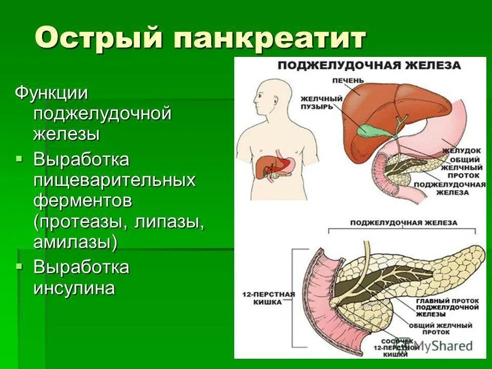 Панкреатит что это симптомы. Симптомы острого панкреатита поджелудочной. Воспаление поджелудочной железы симптомы. Острый панкреатит поджелудочной железы. Полжулудочнаяжелеза симптомы.