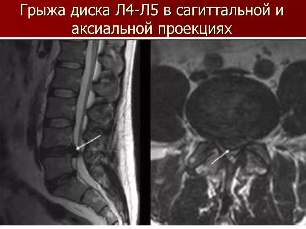 Аксиальный срез мрт l5-s1. Грыжа позвоночника л4 л5. Грыжа позвоночника поясничного отдела на кт.