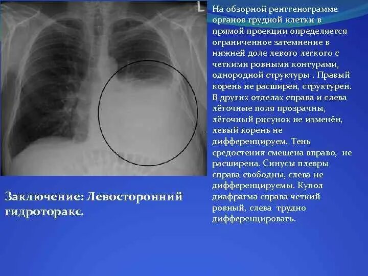 Плотный наблюдаться. Рентген ОГК гидроторакс. Правосторонний Тотальный гидроторакс. Правосторонний малый гидроторакс. Левосторонний Тотальный гидроторакс.