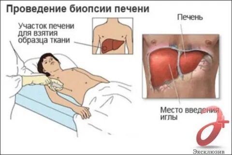 Проведение биопсии печени