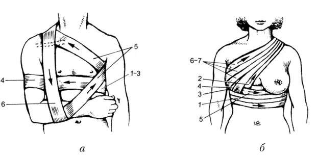 Повязка Дезо на молочную железу. Наложение повязки на грудь Дезо. Дезо перевязка грудной клетки. Бинтовая повязка на молочную железу.
