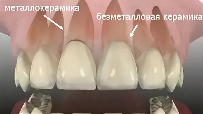 коронка диоксид циркония и металлокерамика. коронка металлокерамика и диоксид циркония разница. металлокерамика или керамика. безметалловая керамика диоксид циркония. металлокерамика и безметалловая керамика.