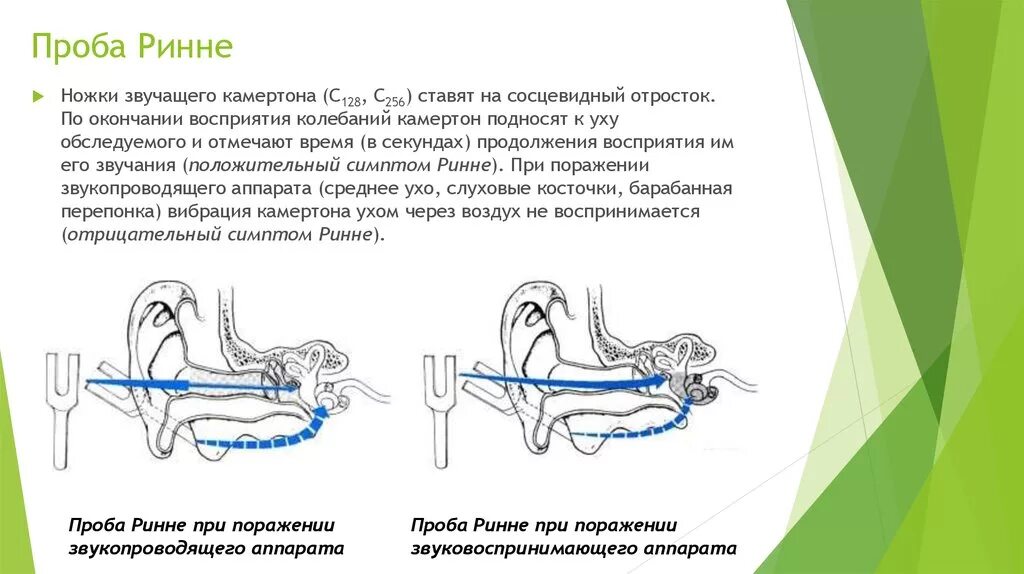 Проба камертонами. Опыт ринне в норме. исследование слуха камертонами норма. исследование слуховой функции камертонами. проба вебера слух.