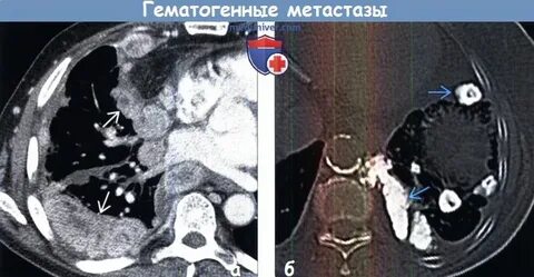 Метастазы опухоли щитовидной железы