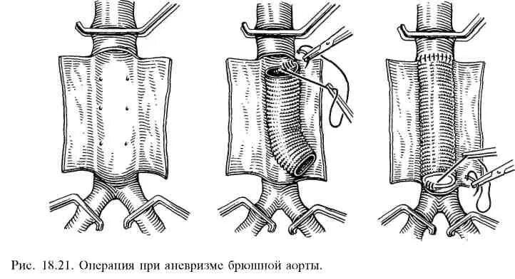 Аневризма брюшной аорты резекция. Эндопротезирование брюшной аорты. Операция при аневризме аорты. Абдоминальная аортальная аневризма. Аорта брюшной полости операция