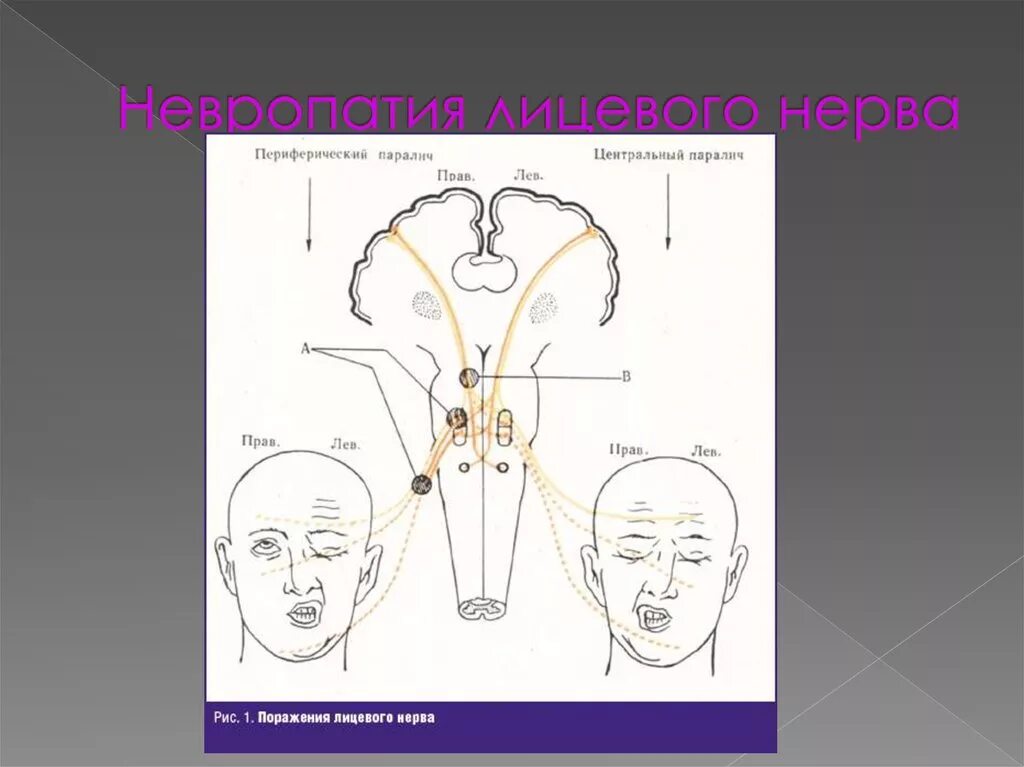 Периферический лицевой паралич. Невропатия лицевого нерва. Посттравматическая нейропатия лицевого нерва. Центральный и периферический паралич лицевого нерва. Центральный парез лицевого нерва