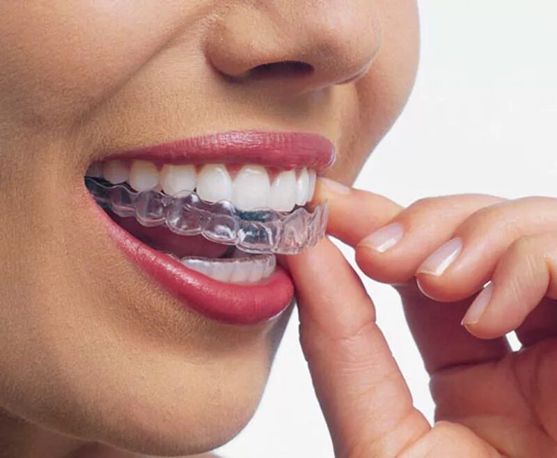 Элайнеры star smile. Ортодонтическая капа элайнеры. Капа вместо брекетов. Капа вместо брекетов. Элайнеры инвизилайн.