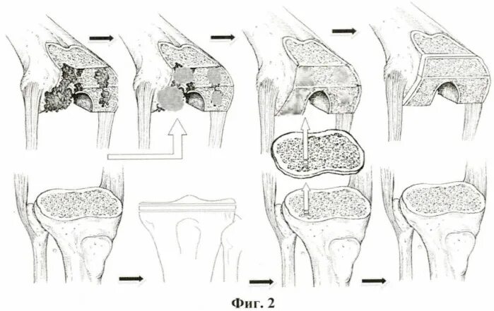 Мыщелки колена. Мыщелка большеберцовой кости. Остеотомия большеберцовой кости. Эндопротез бедренной кости коленного сустава. Перелом мыщелка большеберцовой кости.