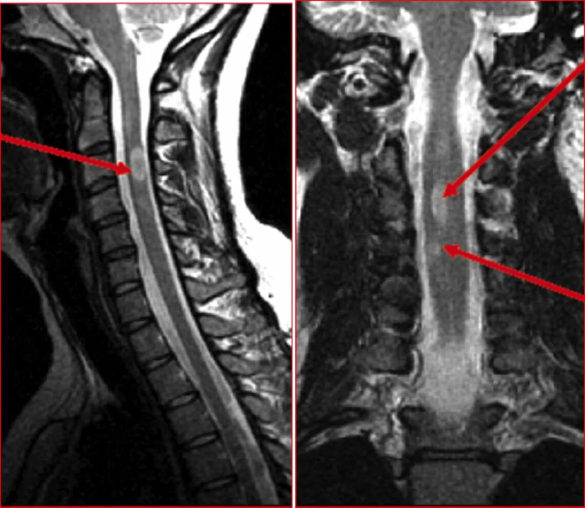 Миелопатия спинного мозга шейного отдела мрт. Миелопатия шейного отдела позвоночника мрт. Рассеянный склероз на мрт позвоночника. Миелопатия спинного мозга мрт. Отек позвоночника после операции