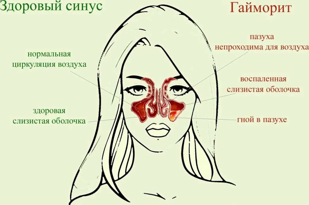 Строение носа при насморке. Острая головная боль температура заложенность носа