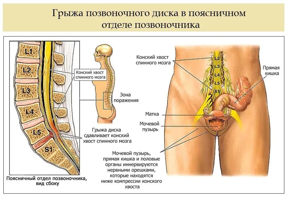 Какую грыжу позвоночника оперируют