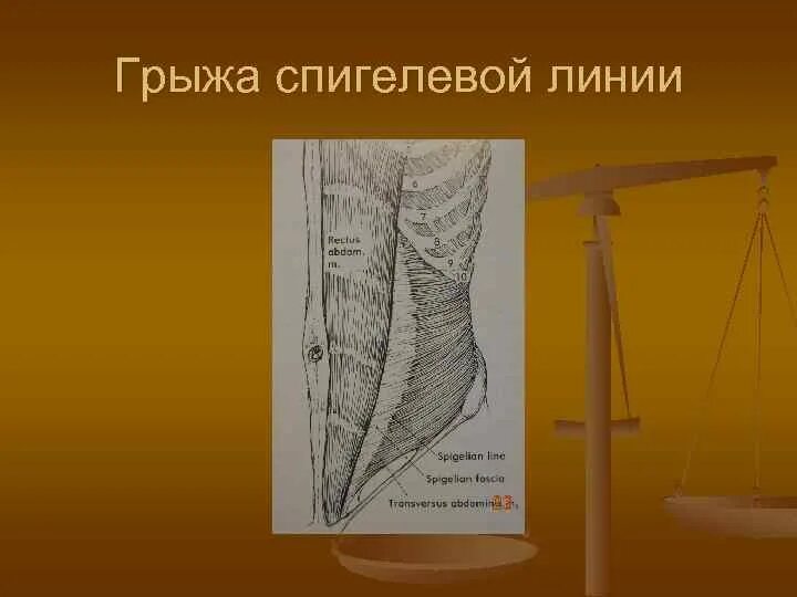 Грыжа спигелиевой линии. Грыжи спигелевой линии. грыжа дугласовой линии. спигелева линия образована. полулунная линия спигеля.