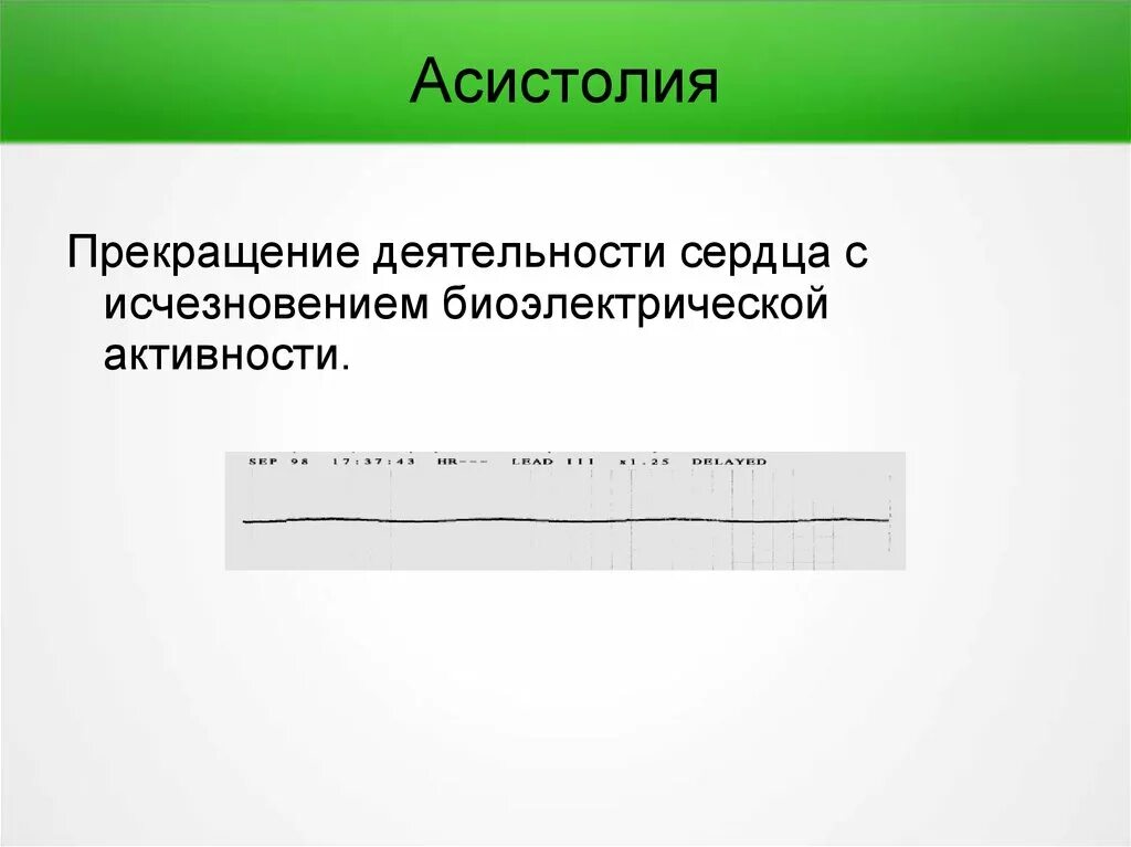 Асистолия что это. Асистолия. Асистолия сердца. Асистолия клиника. Асистолия сердца что это такое и как лечить.