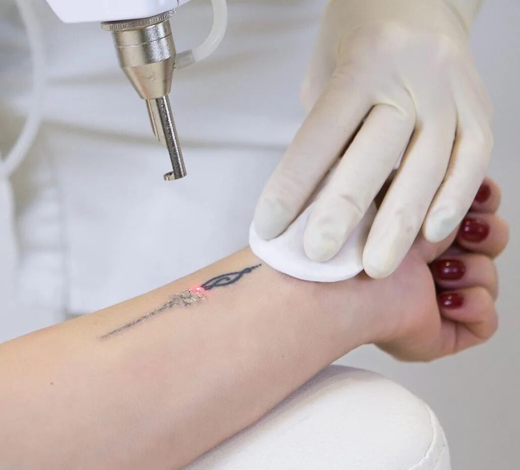 Удаление лазером сочи. Удаление лазером сочи. Удаление татуировок сочи. Выжигание бородавок лазером фото. Карбоновый пилинг улыбается девушка в полный рост.