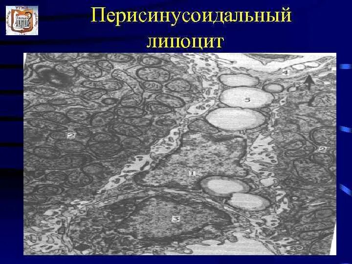 Липоциты. Перисинусоидальный липоцит. Липоцит гистология. Перисинусоидальном пространстве. Перисинусоидальные липоциты развитие.