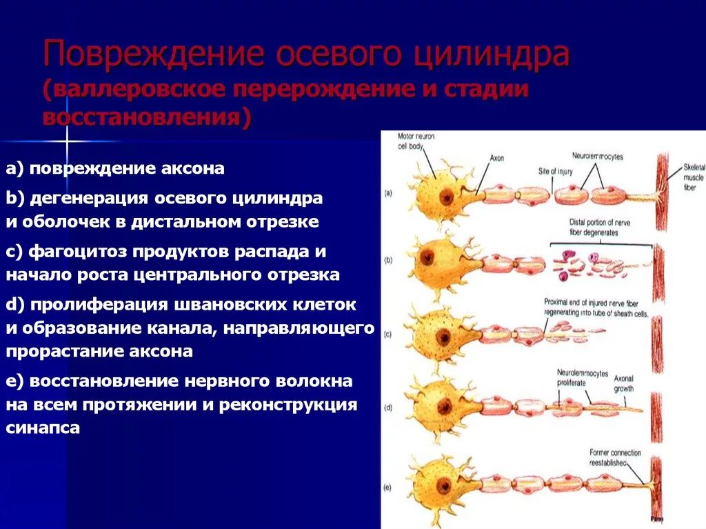 Тип поражения аксональный. Периферический нерв регенерация после повреждения.. Демиелинизация нервных волокон гистология. Регенерация периферического нерва гистология. Регенерация нервных волокон после повреждения.