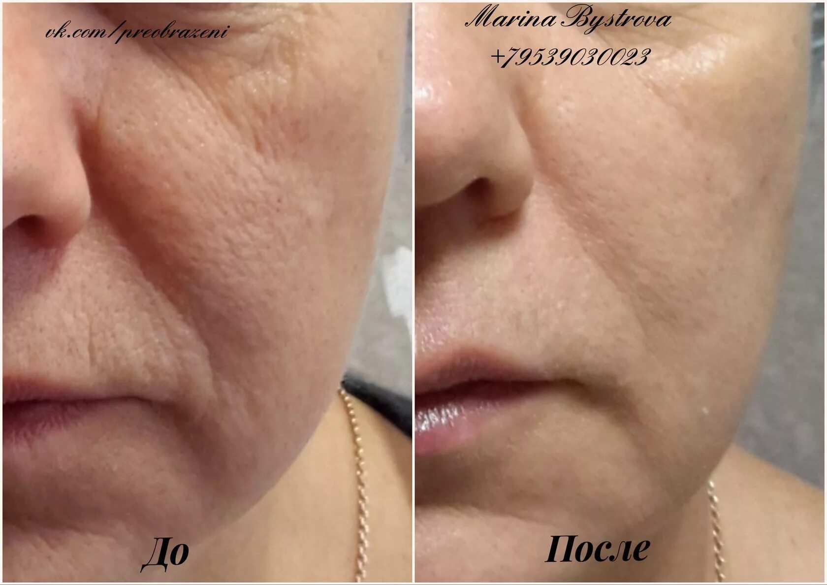 Неинвазивная карбокситерапия до и после. Инъекционная карбокситерапия до после. Карбокситерапия ангиофарм. Карбокситерапия миракл со2. Неинвазивная карбокситерапия до и после.