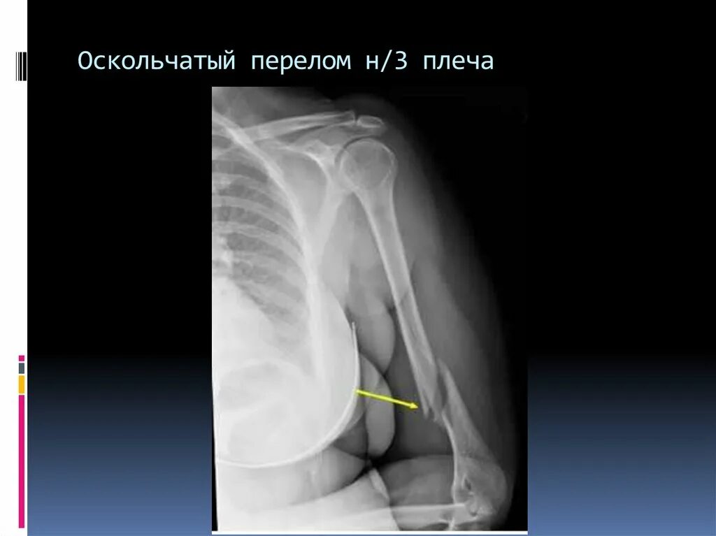 Оскольчатый перелом плеча со смещением. Диафизарный перелом плеча рентген. Оскольчатый перелом плеча со смещением. Оскольчатый перелом плеча со смещением. Оскольчатый перелом плеча со смещением.