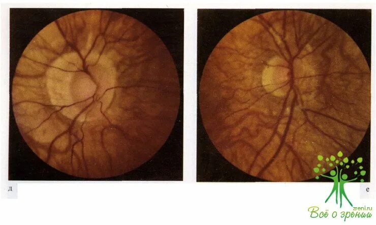 Колобома зрительного нерва. Врожденные аномалии сосудистой оболочки глаза. Аномалии зрительного нерва глаз.