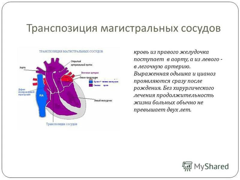 транспозиция магистральных сосудов операция