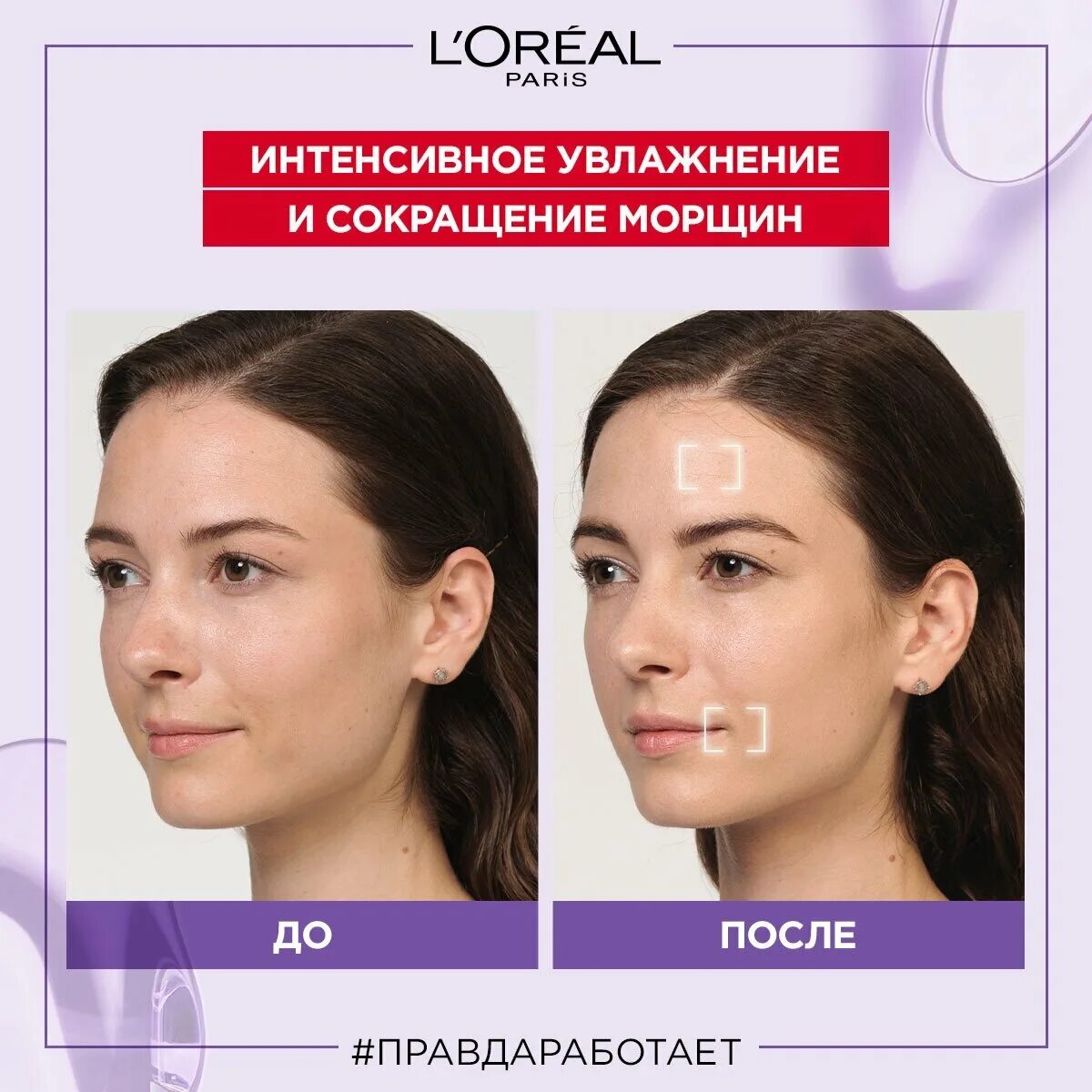 филлеры для лица с гиалуроновой кислотой отзывы