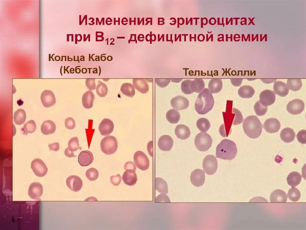 Тельца Жолли и Кебота. Тельца Жолли и кольца Кебота. Кольца Кебота при анемиях. Кольца Кебота и тельца Жолли анемия. Тельце гейнца