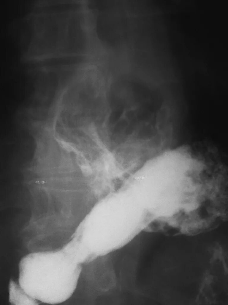 Короткий пищевод рентгенограмма. Короткий пищевод рентген. Врожденный короткий пищевод рентген. Врожденный короткий пищевод.